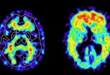 Día Internacional de la Esquizofrenia: afirman que siete de cada diez enfermos no logran acceder a tratamientos adecuados