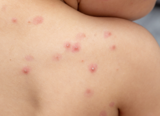 Qué se sabe hasta el momento: datos sobre la «viruela del simio» en nuestro país