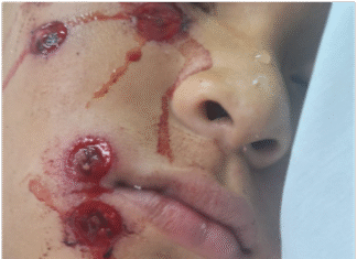 Operativo policial en Quilmes: fuerte acusación al accionar de las fuerzas por dejar a un niño herido con postas de goma